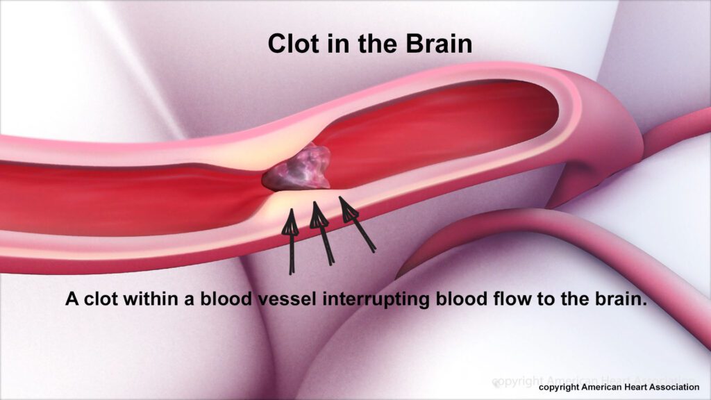 clot in the brain, which occurs from a TIA or stroke