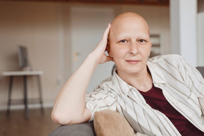women, with alopecia areata, gentle holds her bald head.